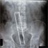 What People Put Inside - Weirdest X-Rays Ever